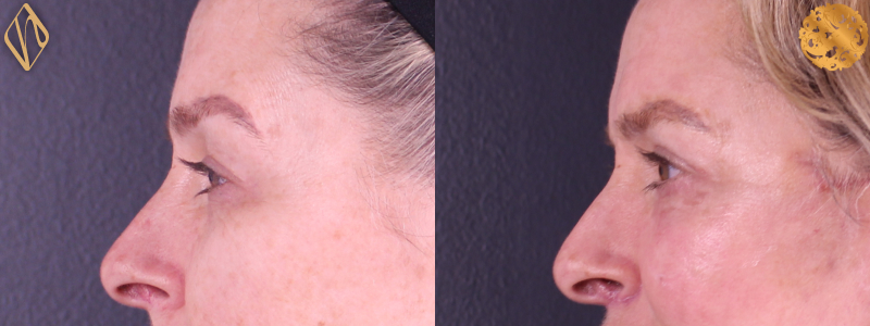 Blepharoplasty 2 Combined Image