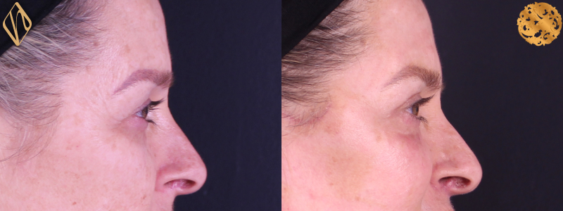 Blepharoplasty 2 Combined Image