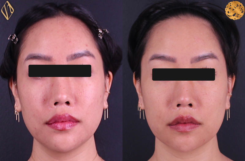 FaceTite 2 Combined Image