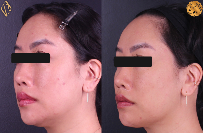 FaceTite 2 Combined Image