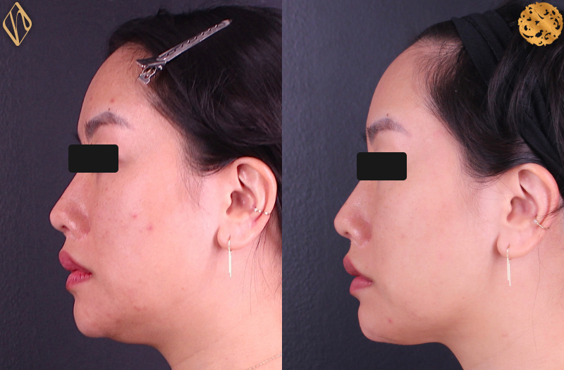 FaceTite 2 Combined Image