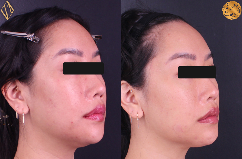 FaceTite 2 Combined Image