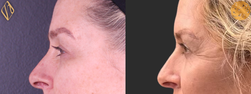 Blepharoplasty 2 Combined Image