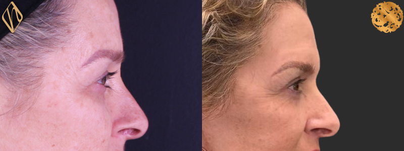Blepharoplasty 2 Combined Image