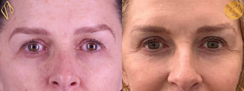 Blepharoplasty 2 Combined Image