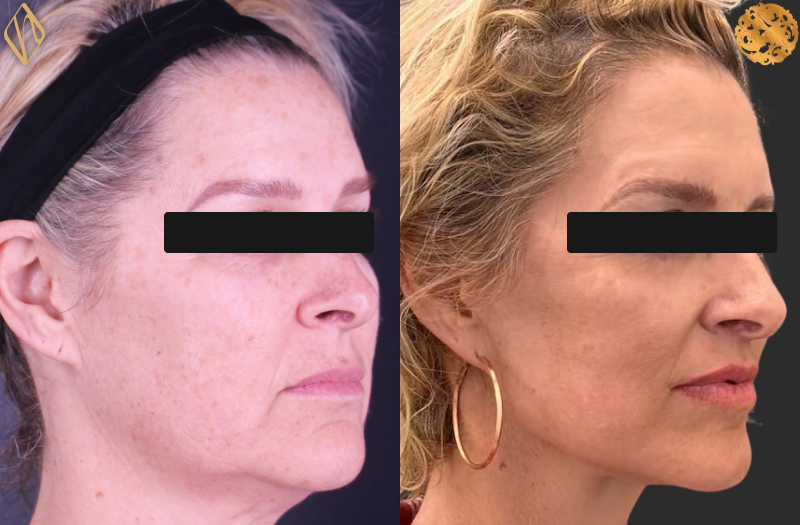 Deep Plane Facelift 1 Combined Image