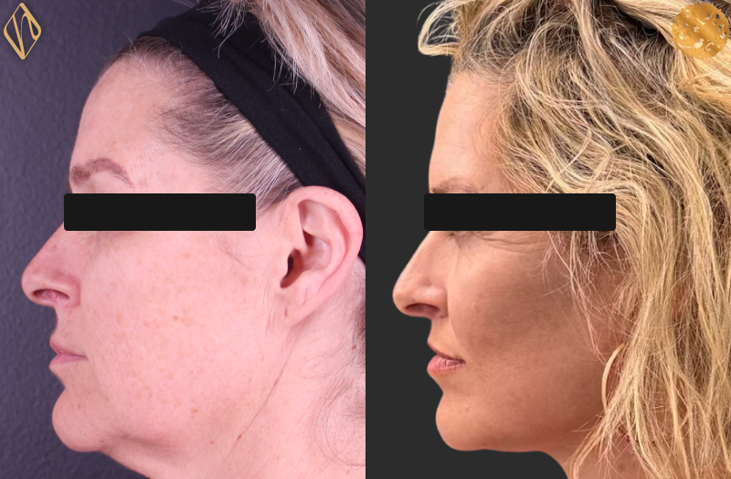 Deep Plane Facelift 1 Combined Image