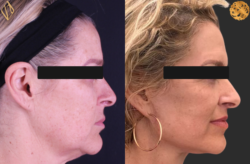 Deep Plane Facelift 1 Combined Image