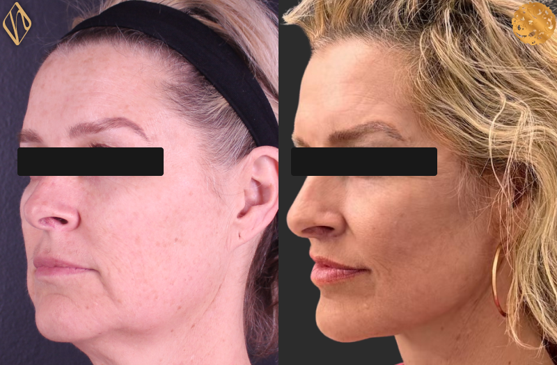 Deep Plane Facelift 1 Combined Image