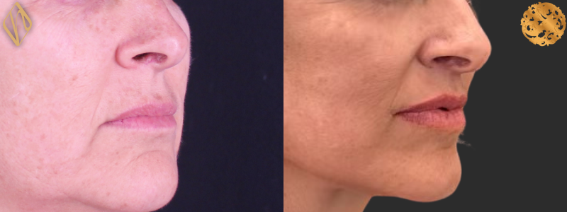 Upper Lip Lift 2 Combined Image