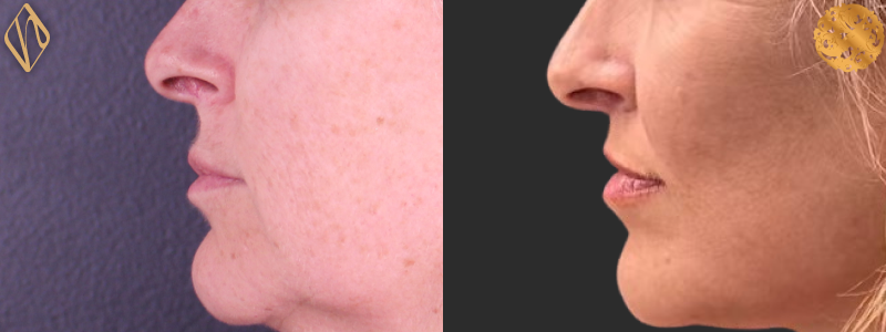 Upper Lip Lift 2 Combined Image