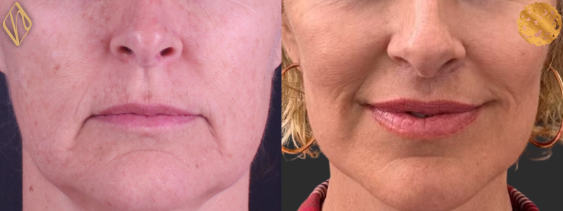 Upper Lip Lift 2 Combined Image