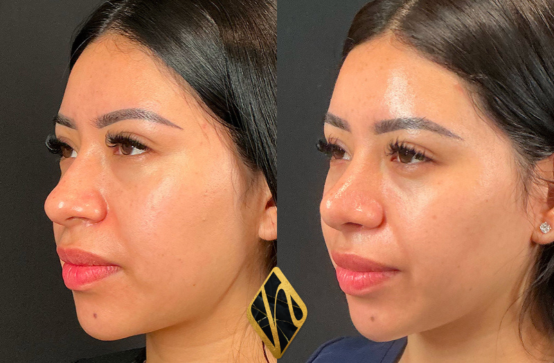 Rhinoplasty Combined Image