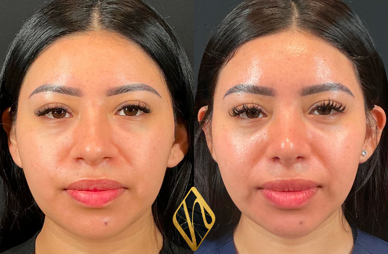 Rhinoplasty Combined Image