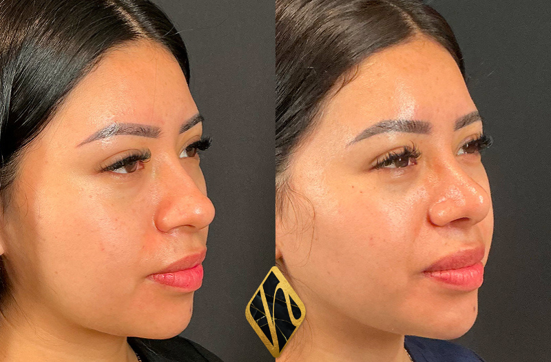 Rhinoplasty Combined Image