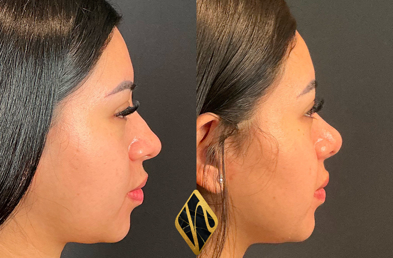 Rhinoplasty Combined Image