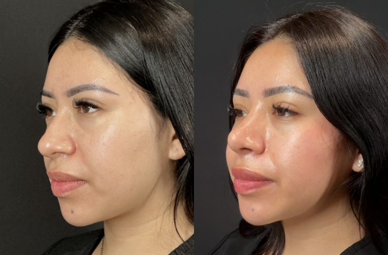 Rhinoplasty 4 Combined Image