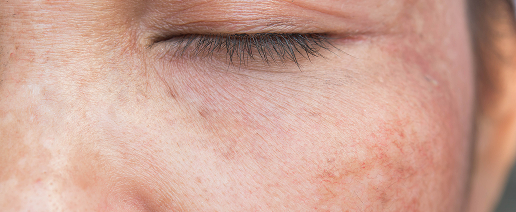 Pigmentation and sun damage