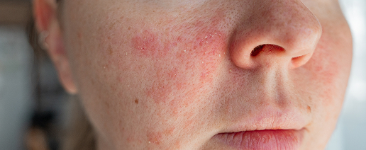 Redness and vascular concerns