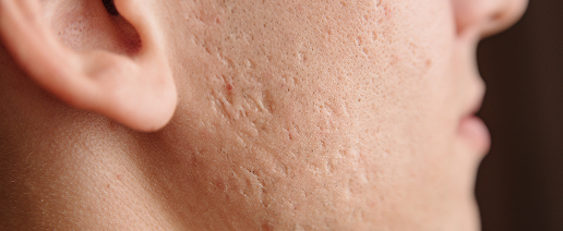 Texture, pores, and acne scarring