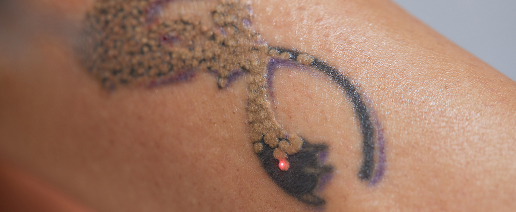Tattoos and unwanted marks