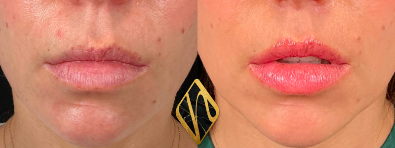 Lip Lift 3 Combined Image