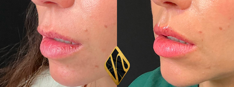 Lip Lift 3 Combined Image