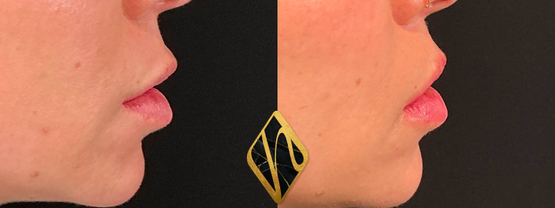 Lip Lift 3 Combined Image