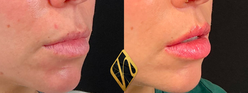 Lip Lift 3 Combined Image