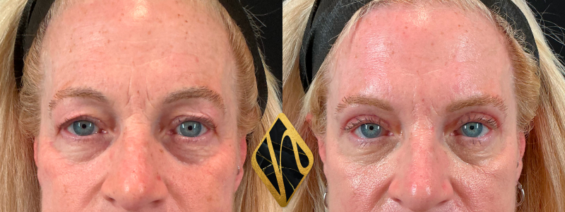 Upper Blepharoplasty 3 Combined Image