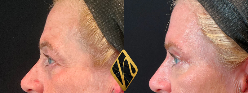 Upper Blepharoplasty 3 Combined Image