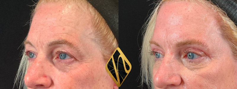 Upper Blepharoplasty 3 Combined Image