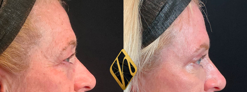 Upper Blepharoplasty 3 Combined Image