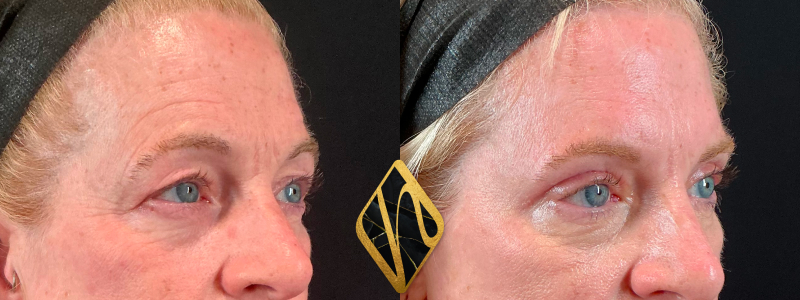 Upper Blepharoplasty 3 Combined Image
